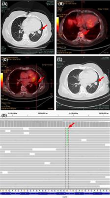 A Lung Cancer Patient Harboring a Rare Oncogenic EGFR Exon 20 V786M Mutation Responded to a Third-Generation Tyrosine Kinase Inhibitor: Case Report and Review of the Literature